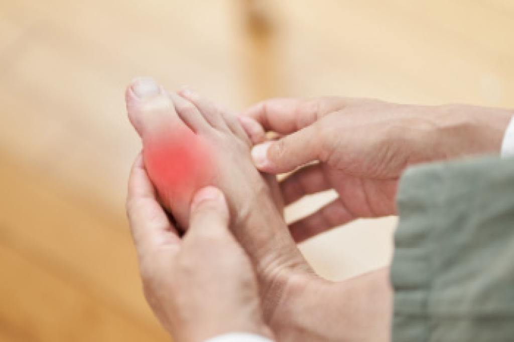 Gout and Its Lasting Impact on the Feet