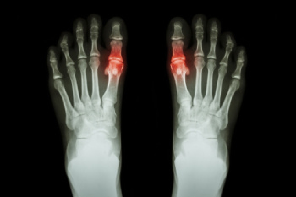 How Gout Is Diagnosed and What the Tests Show