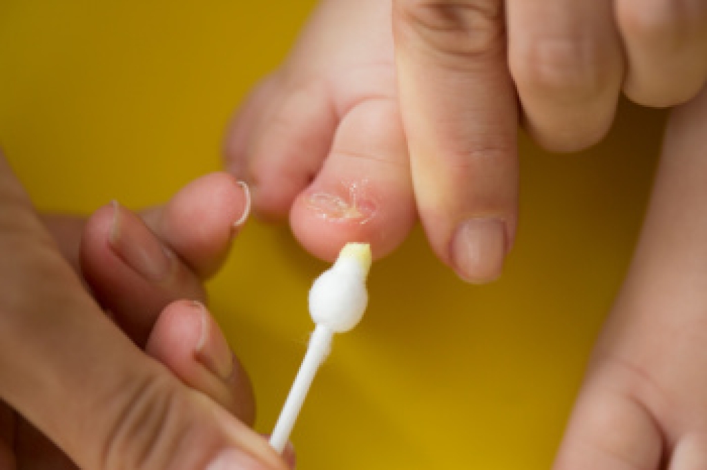 When Baby Has an Ingrown Toenail